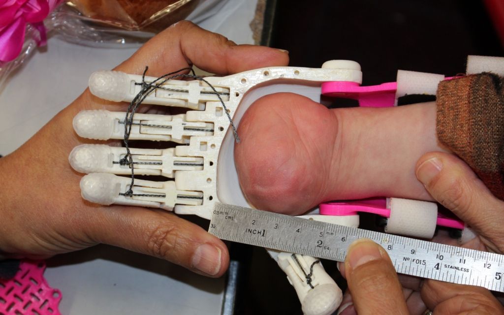 Un joven se prepara para recibir una mano impresa en 3D. Foto cortesía de Haifa 3D.