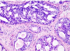 Cáncer de mama: Mammaprint reduce la quimioterapia innecesaria